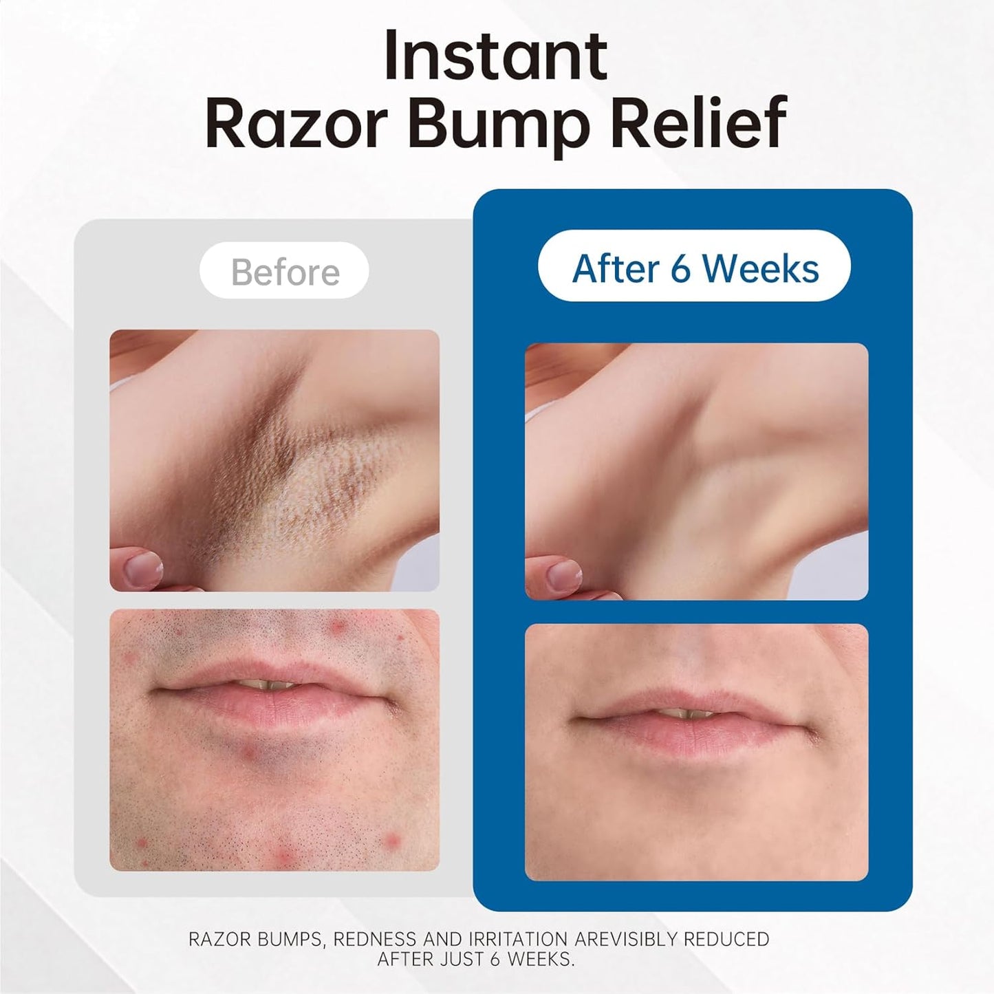 Razor Bumps Ingrown Hair Treatment: 3.38Fl.Oz Smoothing Solution for Body, Beard & Bikini Area Post Waxing after Shaving Serum for Ingrown Hair & Razor Burn - Women & Men
